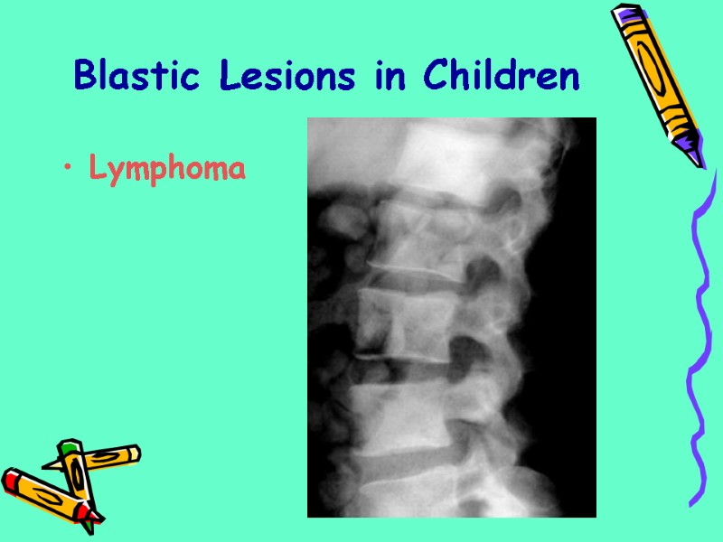 Lymphoma Blastic Lesions in Children